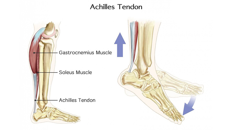 What Is An Achilles Tendon And Why Is It Damaged? 