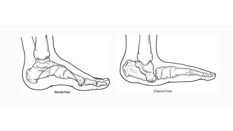 Charcot Foot | Dr Bijan 4 Feet