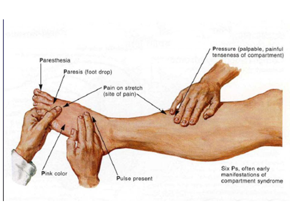 Compartment Syndromes of the Foot