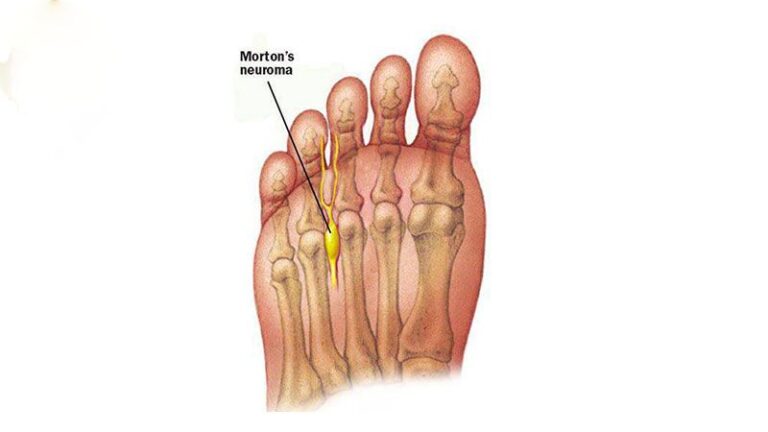 Morton’s Neuroma | Dr Bijan 4 Feet