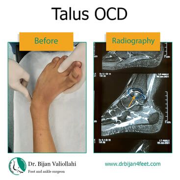 Osteochondral Defects (OCD) of the Ankle | Dr Bijan 4 Feet