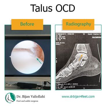 Osteochondral Defects (OCD) of the Ankle | Dr Bijan 4 Feet