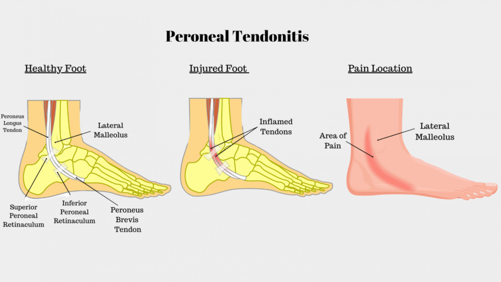 Peroneal Tendon Injury | Dr Bijan 4 Feet