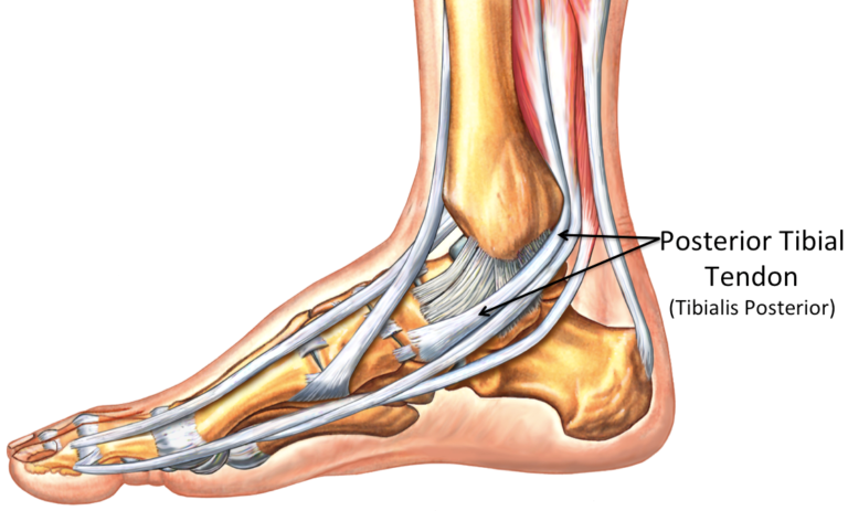 Posterior Tibial Tendon Rupture | Dr Bijan 4 Feet