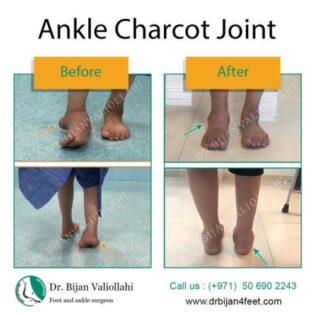 Ankle Charcot Joint | Dr Bijan 4 Feet
