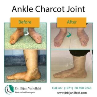 Ankle Charcot Joint | Dr Bijan 4 Feet