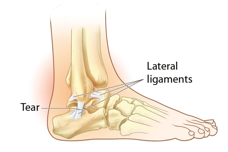 Ankle Ligament Tear Dr Bijan 4 Feet