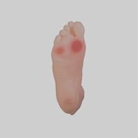 charcot foot treatment in dubai