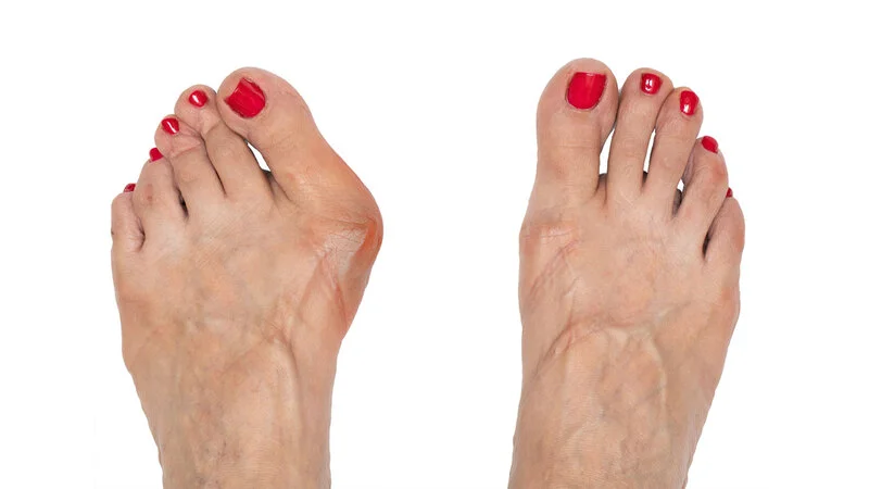 Complications caused by a bunion deformity