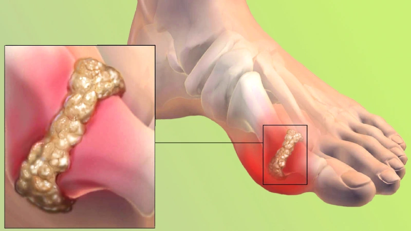 How does gout develop?
