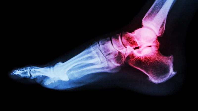 How is gout diagnosed?