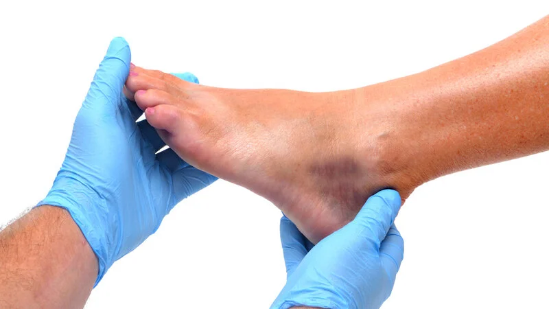 How to diagnose an ankle sprain?
