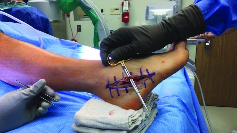 Surgery for peroneal tendon rupture
