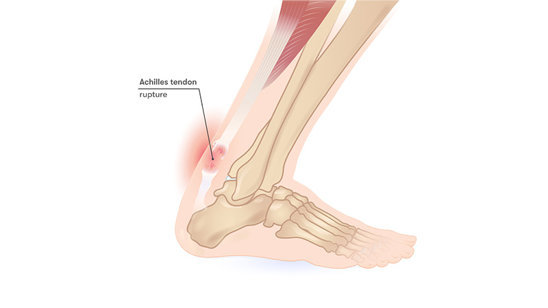 Symptoms of Achilles tendon rupture