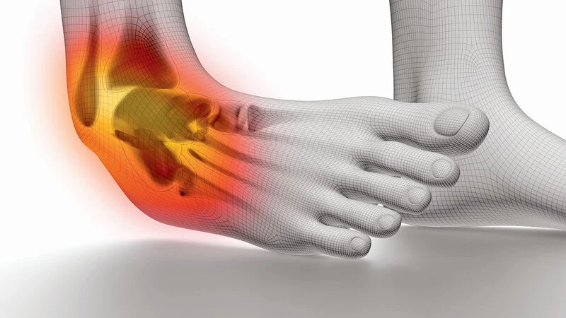 The cause of an ankle sprain