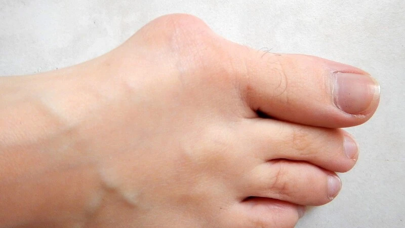 The cost of bunion deformity surgery