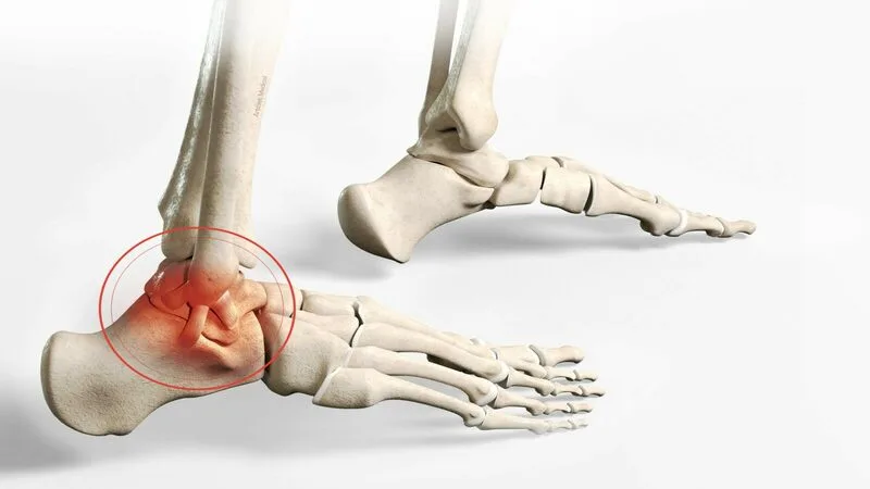 The causes of ankle disc osteochondritis