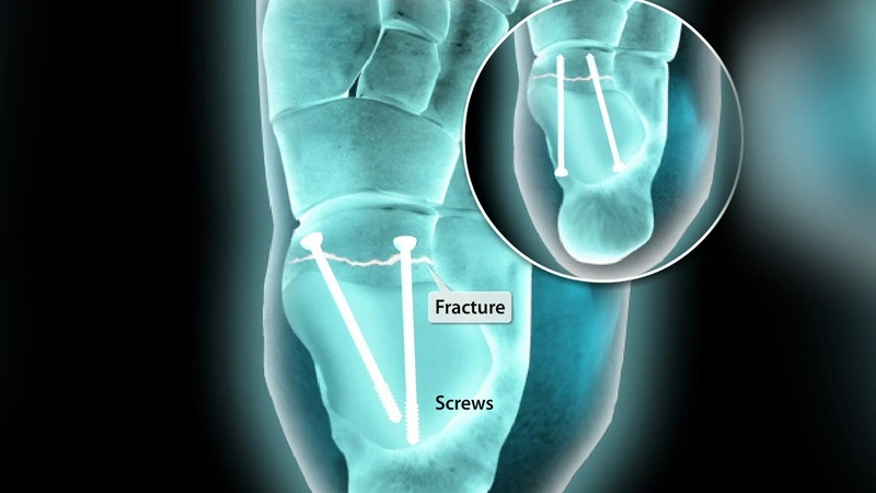 Types of the Talus Bone Fractures