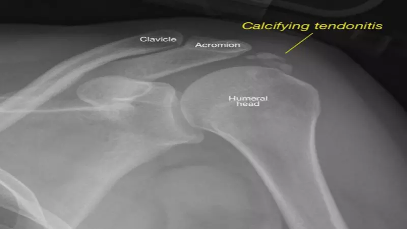 What Is Calcified Tendonitis?