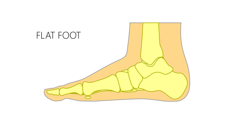 What causes flat feet?