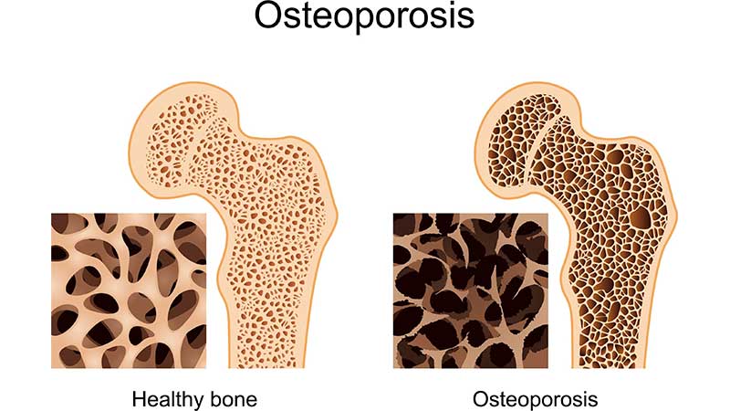 What causes osteoporosis?