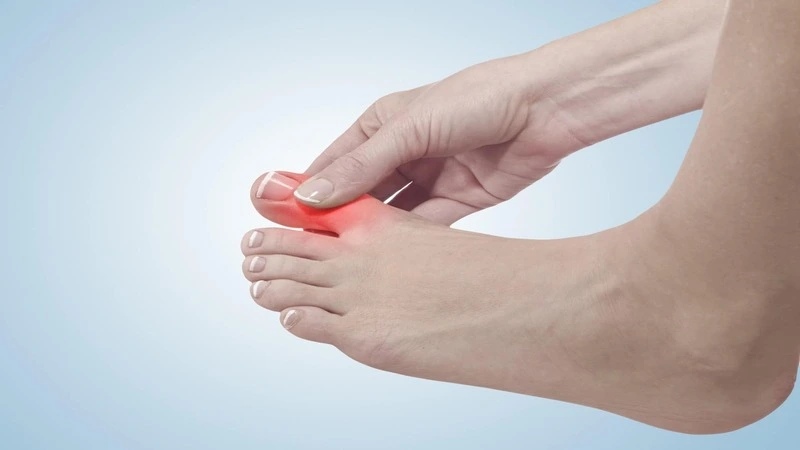 Can you have a bunion deformity and still have a straight toe? -  Orthopaedics 360