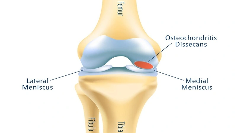 What is ankle disc osteochondritis?