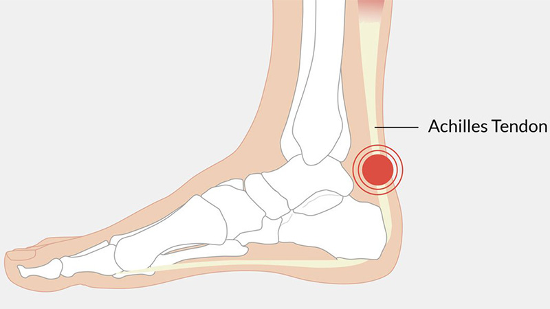 What is the Achilles tendon?