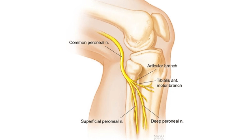 Treatment of peroneal nerve entrapment