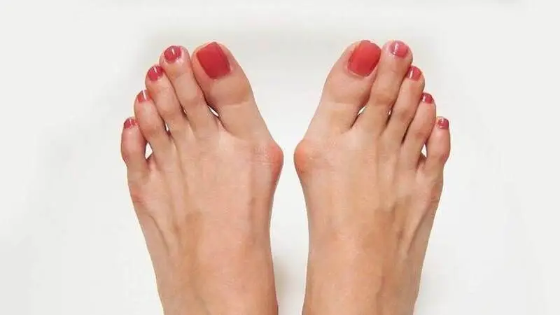 When should you see a doctor for a bunion deformity?